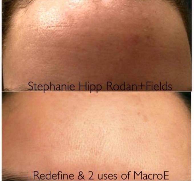 A close up of two foreheads before and after using Rodan and Fields products.