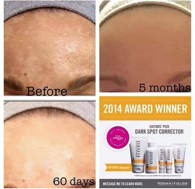 Collage of pictures of a woman\'s forehead showing before and after pictures with pictures of the Rodan and Fields products.