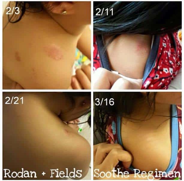 before & after  kids eczema 